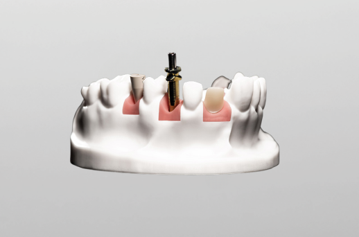 3D Modell - Implantatversorgung